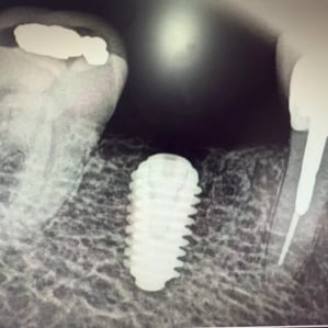 What Implant Is That?
