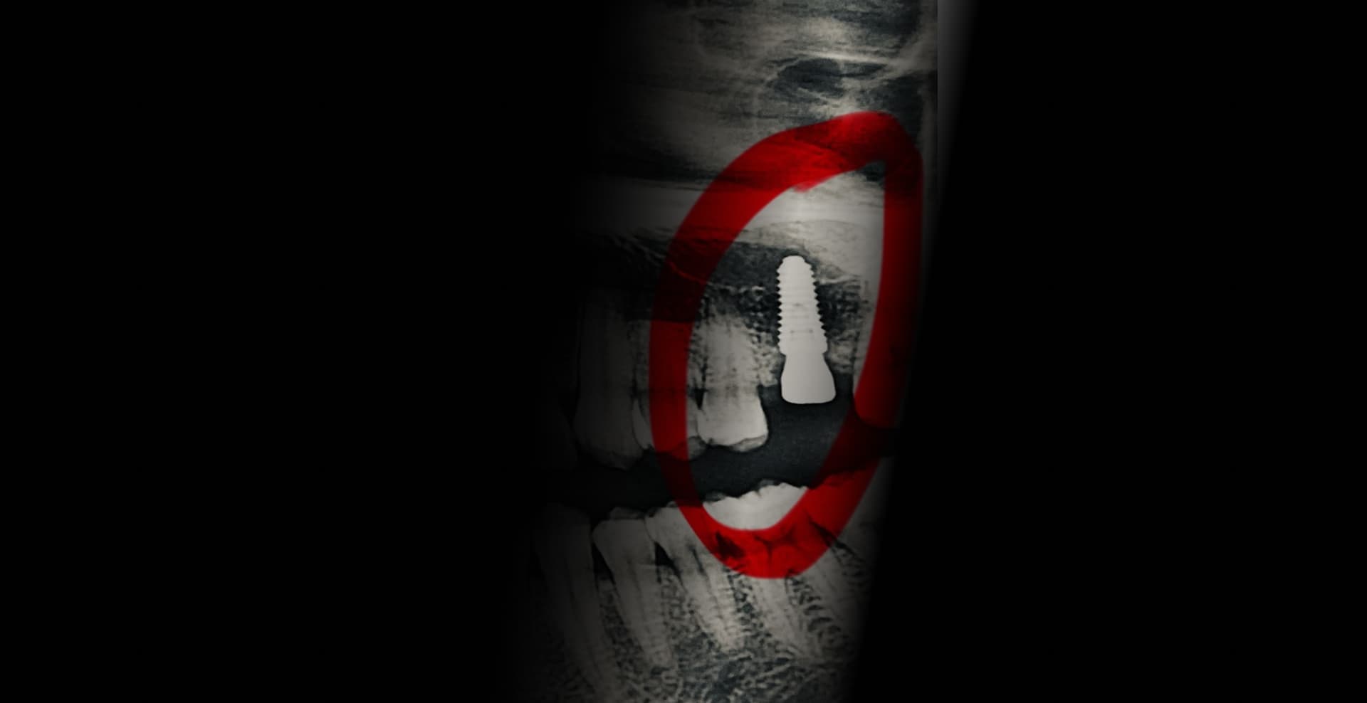 Live dental implant surgery training